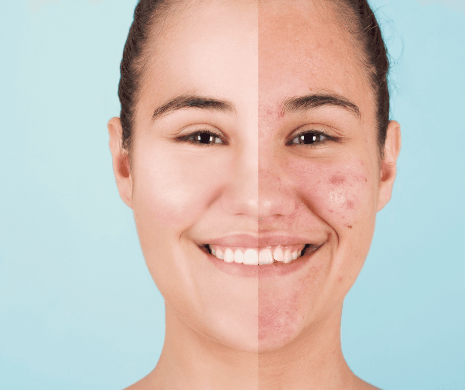 Listening to the Skin: A Ritual of Home Care for Oily and Problematic Complexions